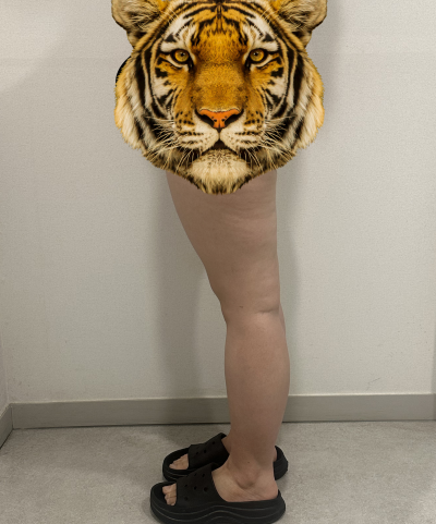 허벅지지방흡입 후기 [대용량, 사진, 지방량 정리]