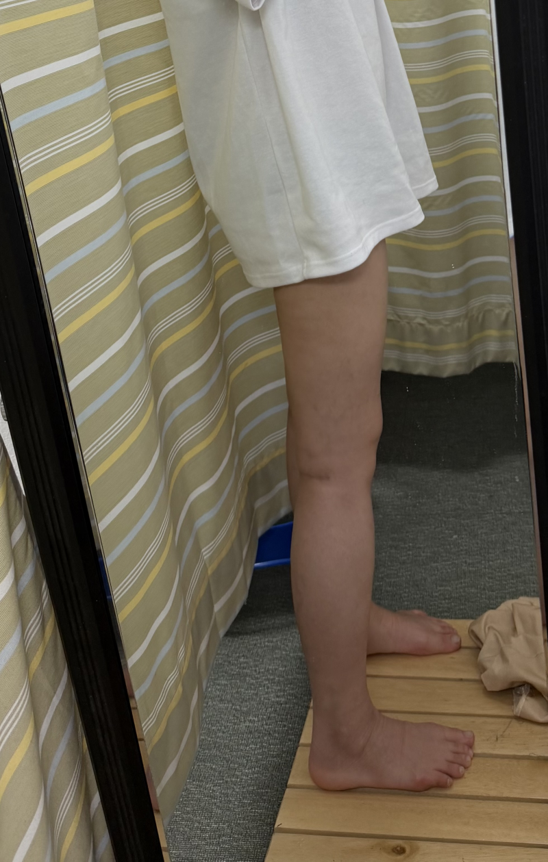 허벅지지방흡입 후기 [대용량, 사진, 지방량 정리]