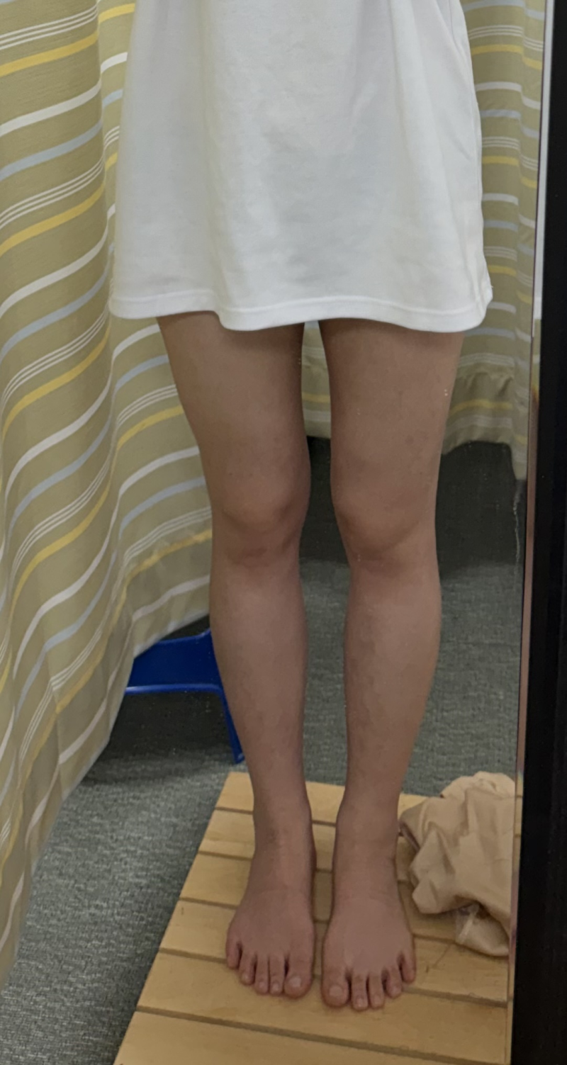 허벅지지방흡입 후기 [대용량, 사진, 지방량 정리]