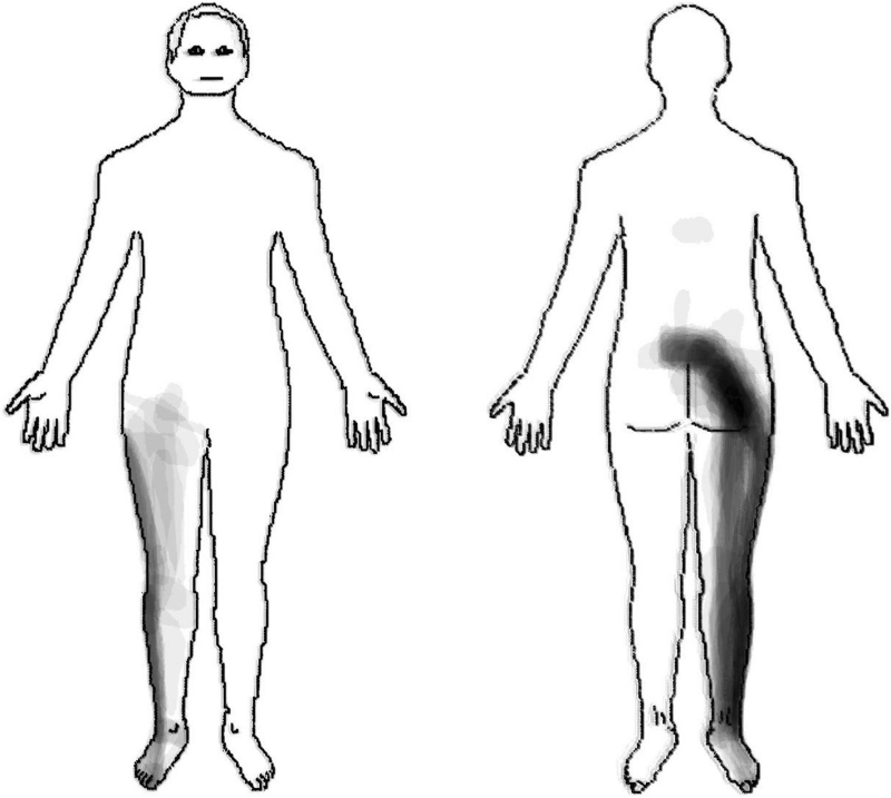 옥정정형외과, 허리보다 다리가 더 당기면 디스크일까요?